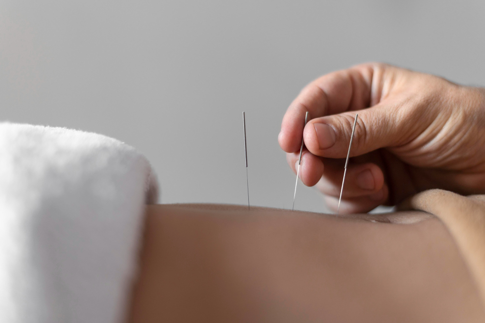 pose d'aiguille pour pratiquer de l'acupuncture