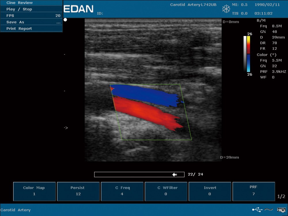 Echographe avec doppler couleur