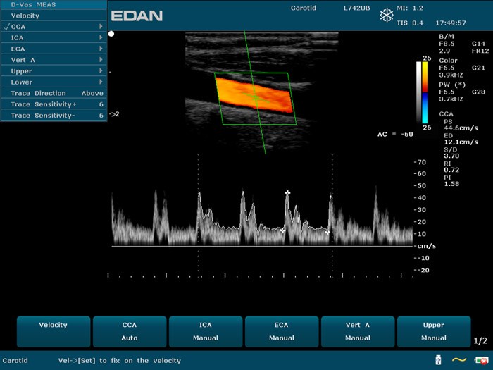 auto-doppler-carotide.jpg